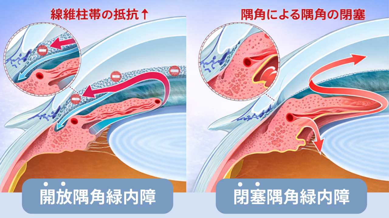 開放隅角緑内障と閉塞隅角緑内障の違いを示した比較図
