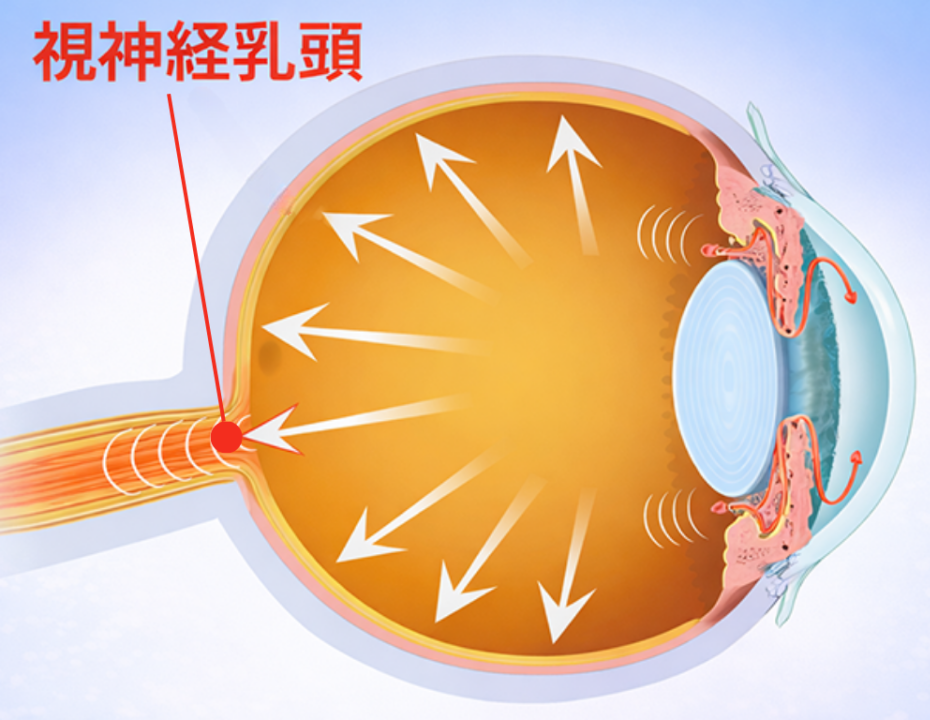 眼圧上昇が視神経乳頭に負荷をかけ、視野障害につながるイメージ図