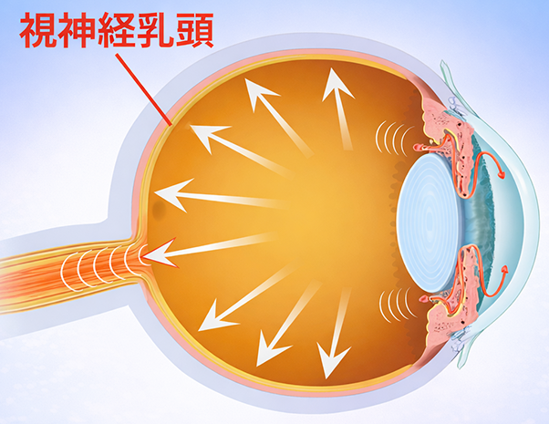 眼圧上昇が視神経乳頭に負荷をかけ、視野障害につながるイメージ図