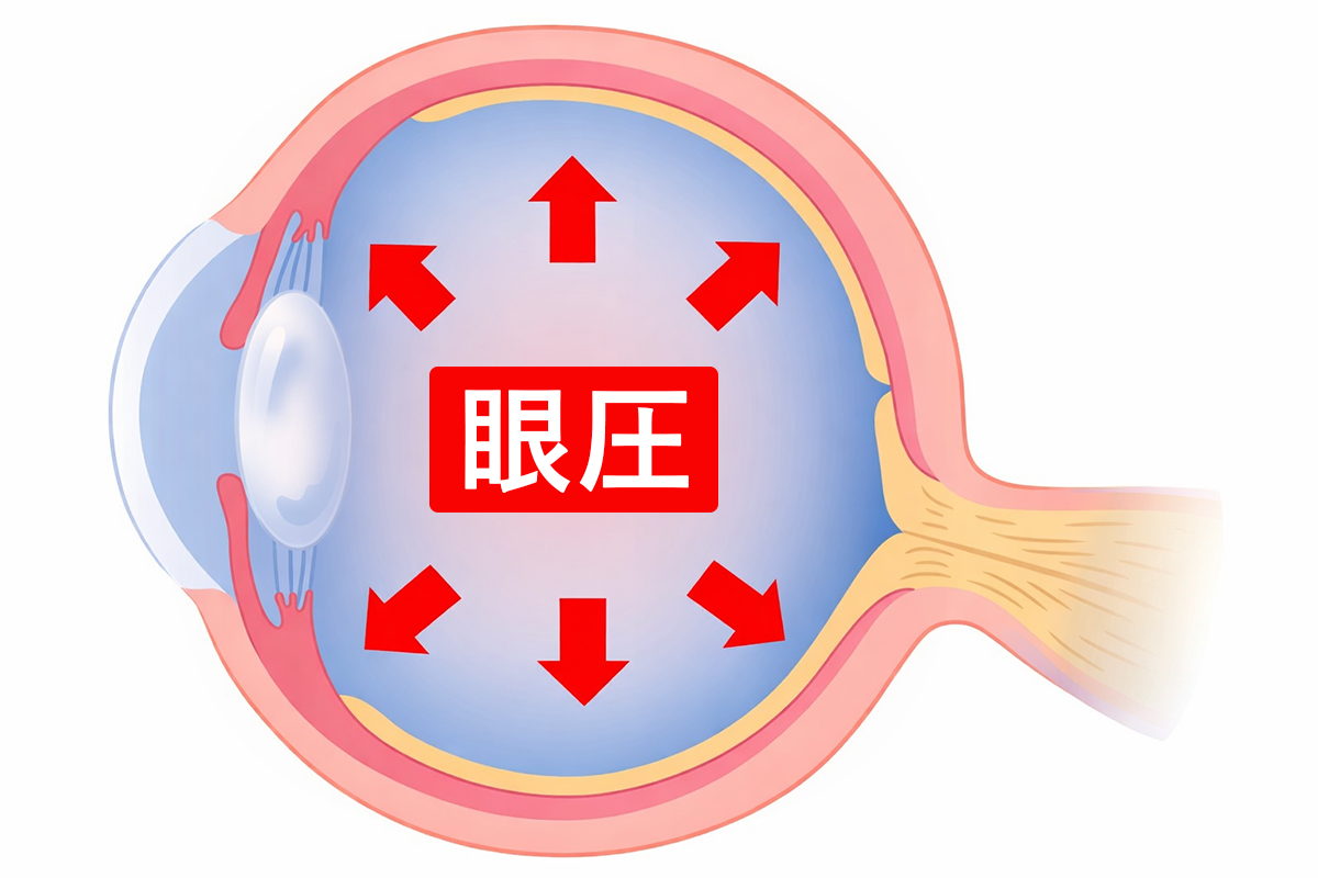 眼球断面図で示した眼圧（IOP）のイメージ図