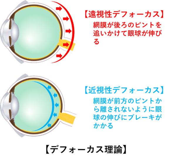 近視進行の原因となる遠視性デフォーカスと抑制する近視性デフォーカスの仕組み図