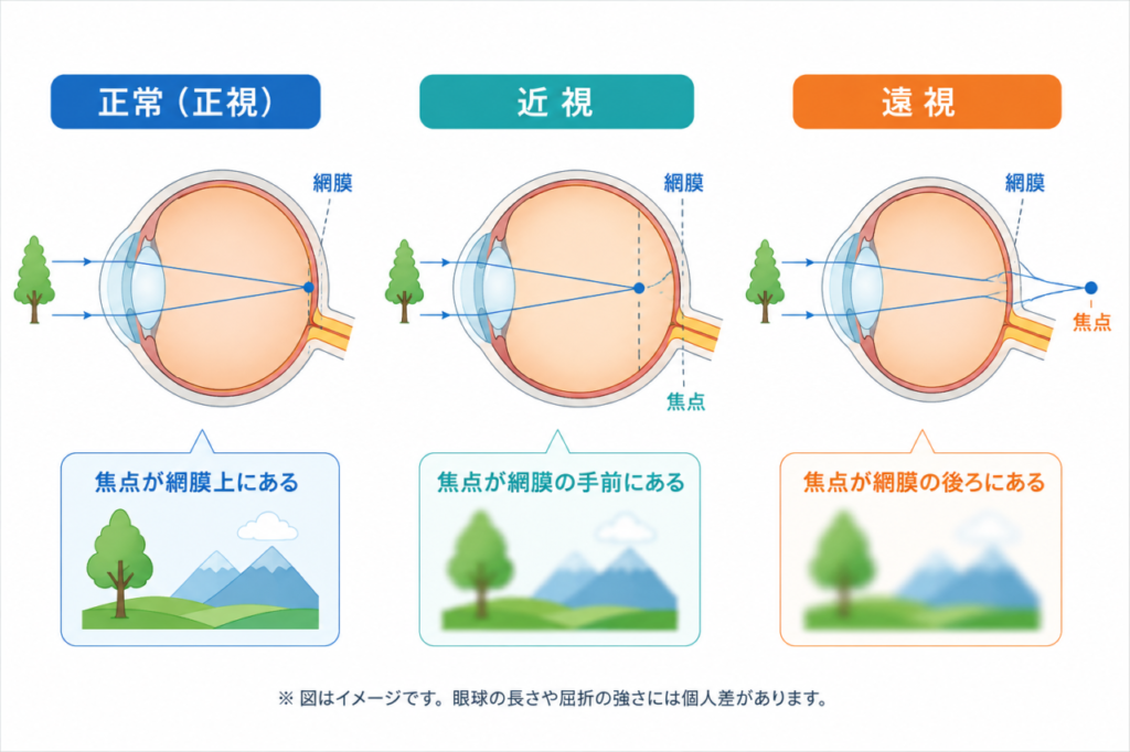 正常・近視・遠視で光の焦点位置を比較したシンプルな図